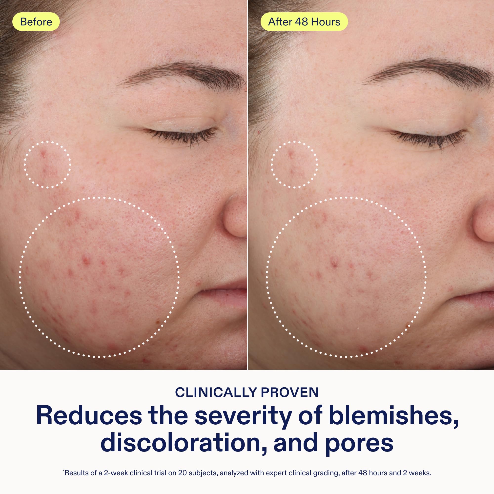Skinfix triple threat mini Adapinoid Gel application demonstrates gentle texture refinement
