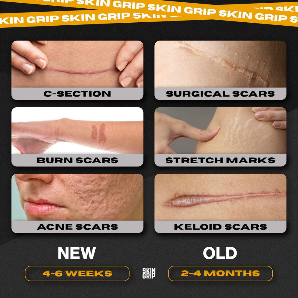 Skin Grip protects burn areas while maintaining a comfortable, moist environment.