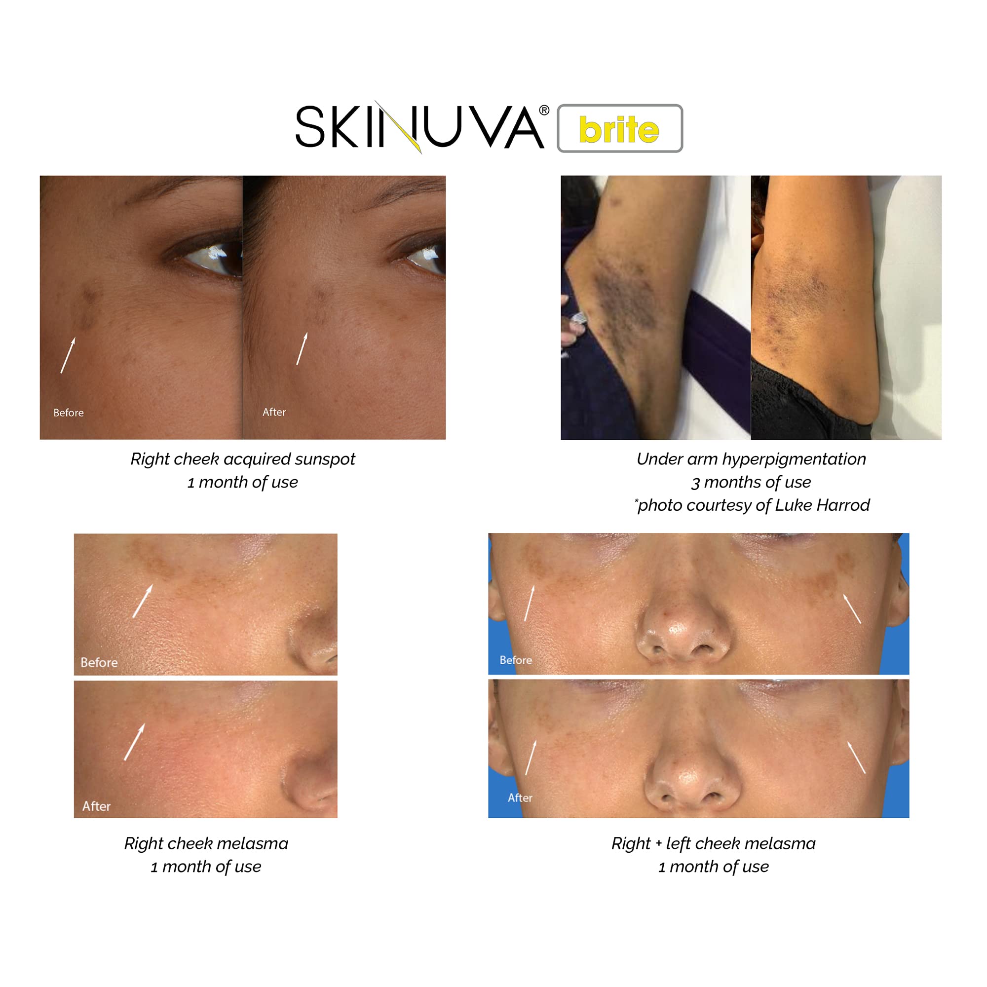 Skinuva Brite ingredients card highlighting growth factors, tranexamic acid, and niacinamide