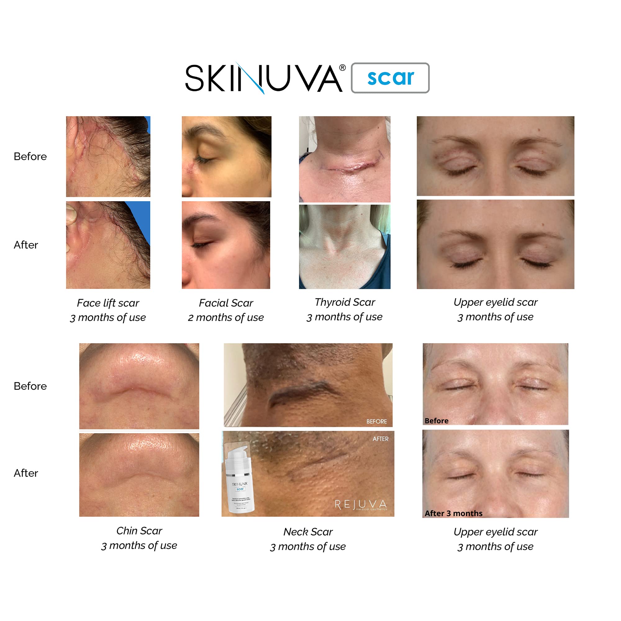 Skinuva usage tips for twice-daily application on scar-prone areas