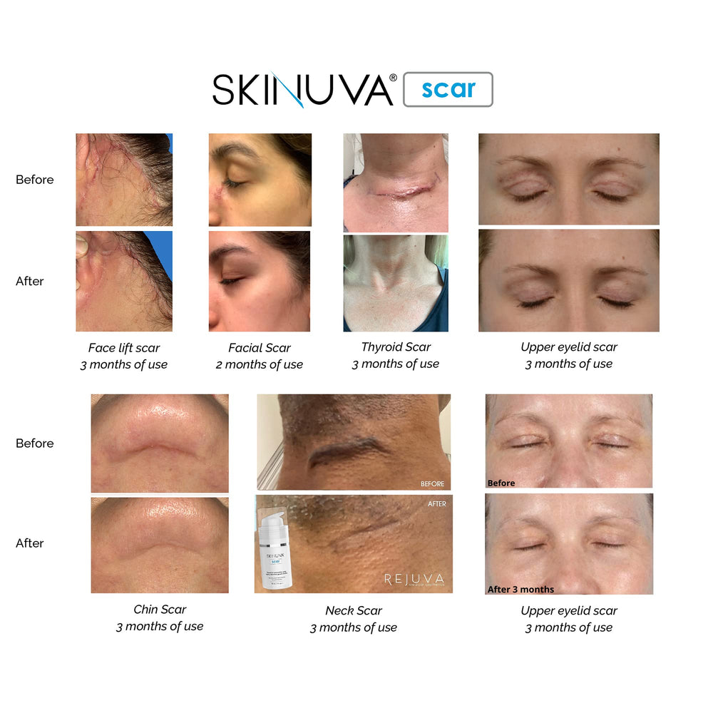 Skinuva usage tips for twice-daily application on scar-prone areas