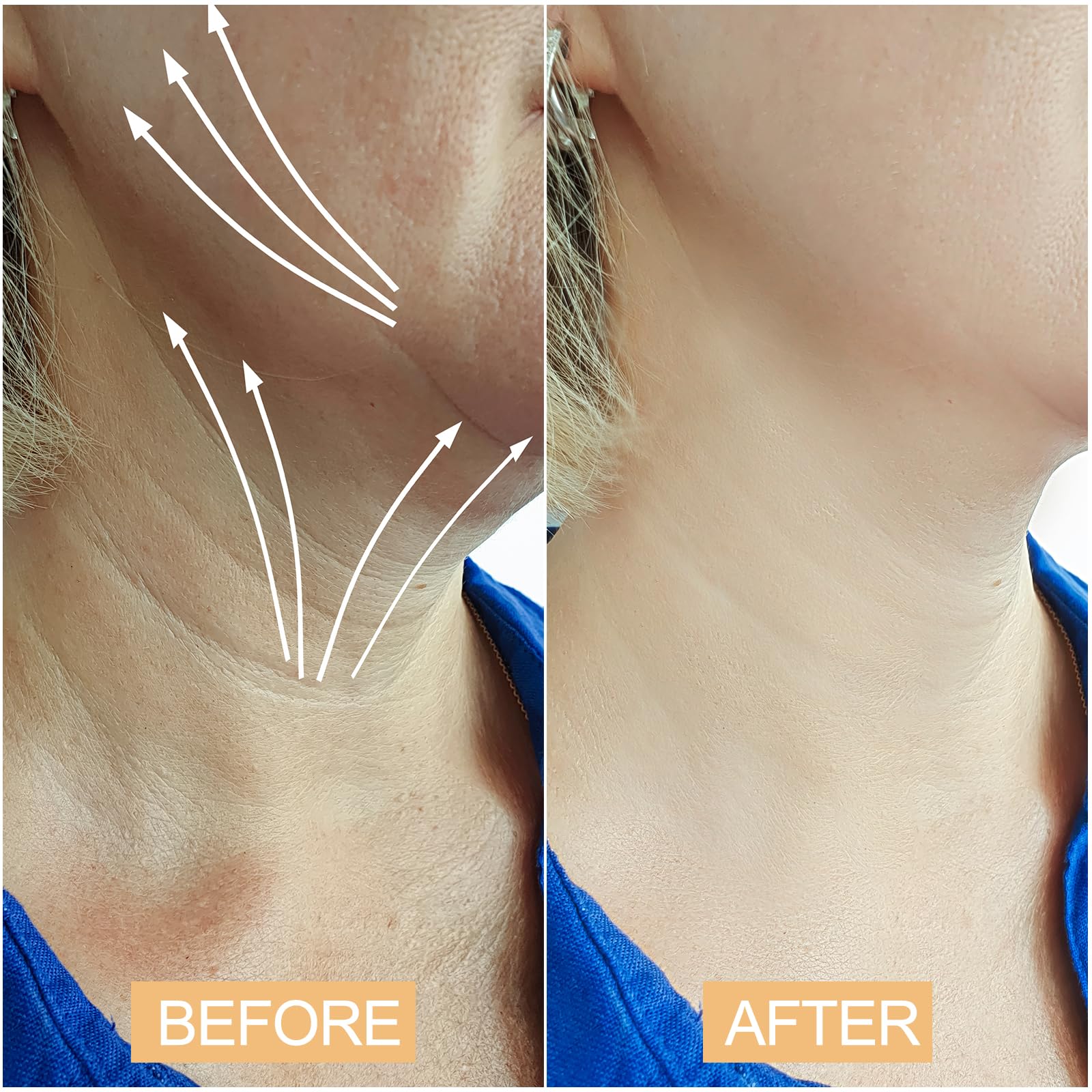 Snifflink Neck Lifting Tape uses invisible adhesive for discreet wear under clothing.