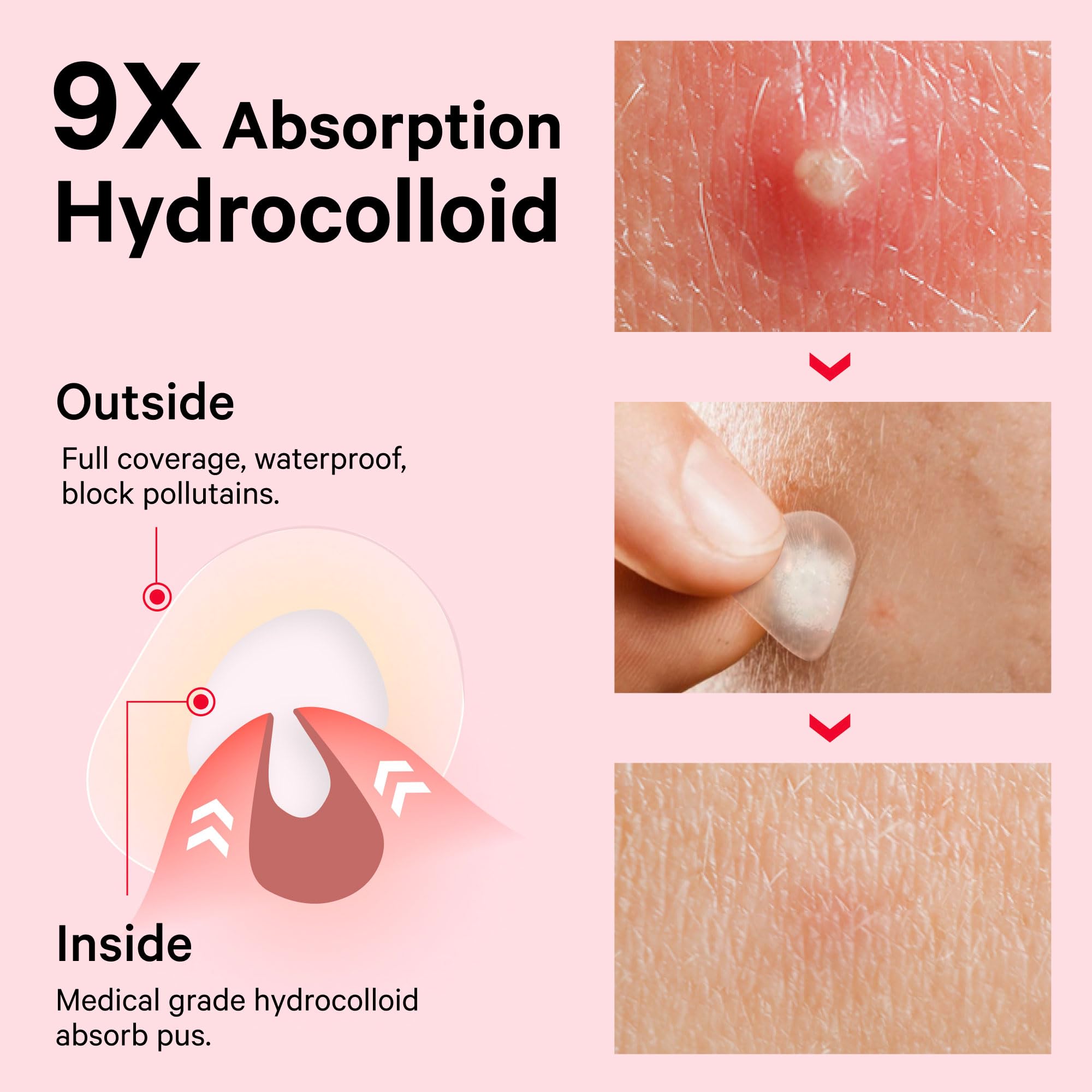 Sosky patches feature tea tree oil and salicylic acid for targeted care.
