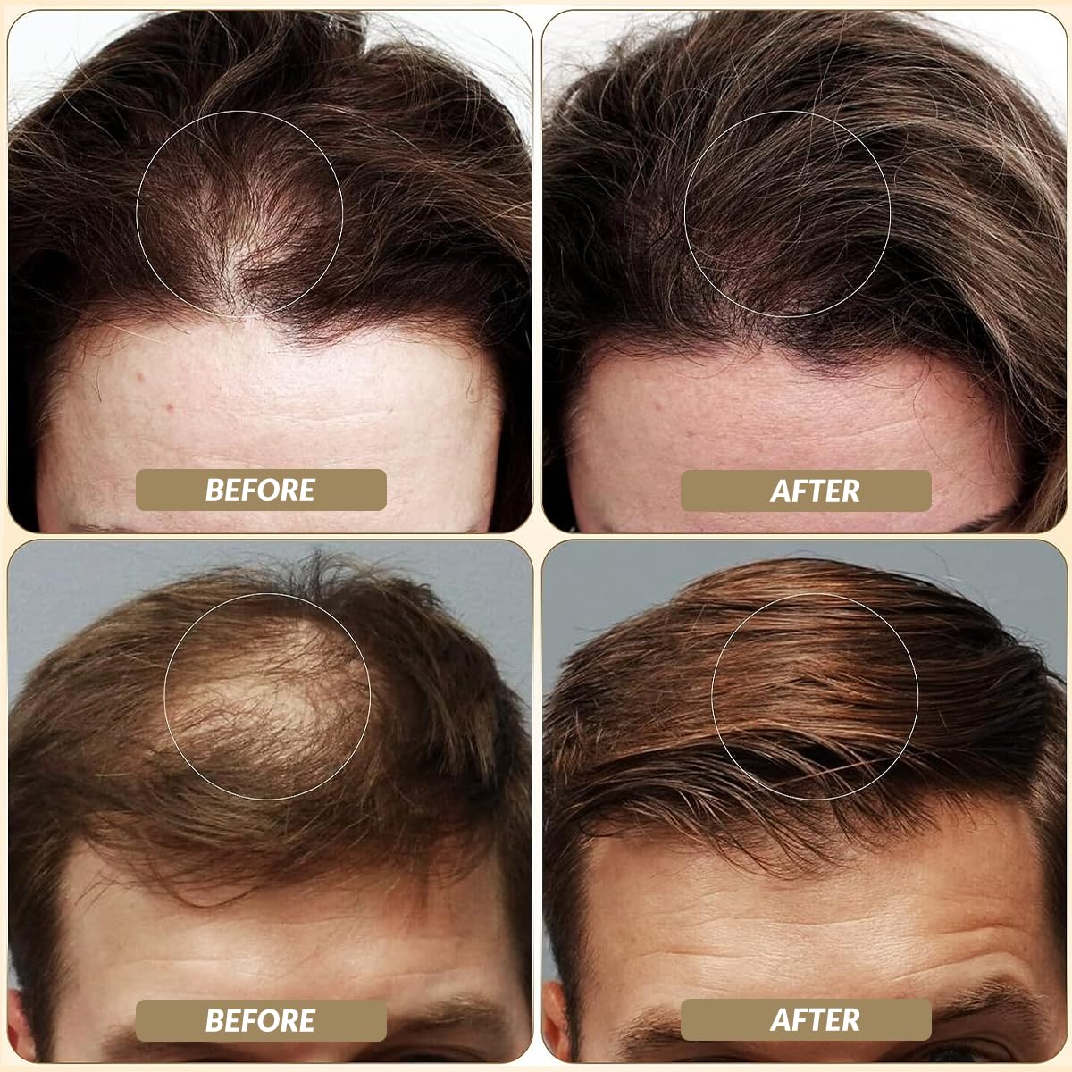 SOVONCARE hair fibers on bald spot provide instant concealment and seamless blend.