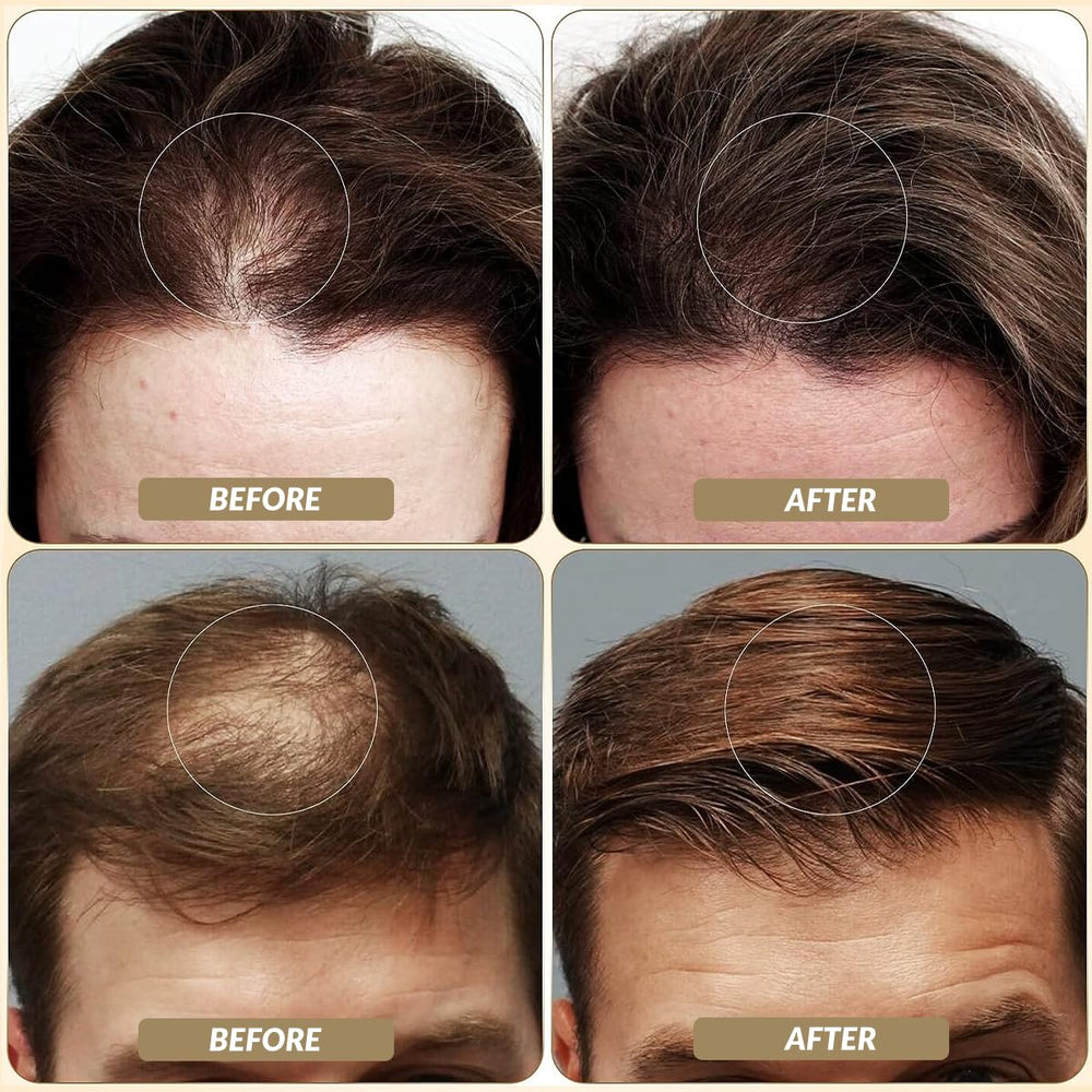 SOVONCARE hair fibers on bald spot provide instant concealment and seamless blend.