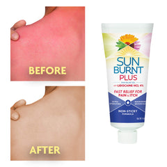 Sunburnt Plus applying on skin demonstrates non-sticky, quick-absorption after-sun gel