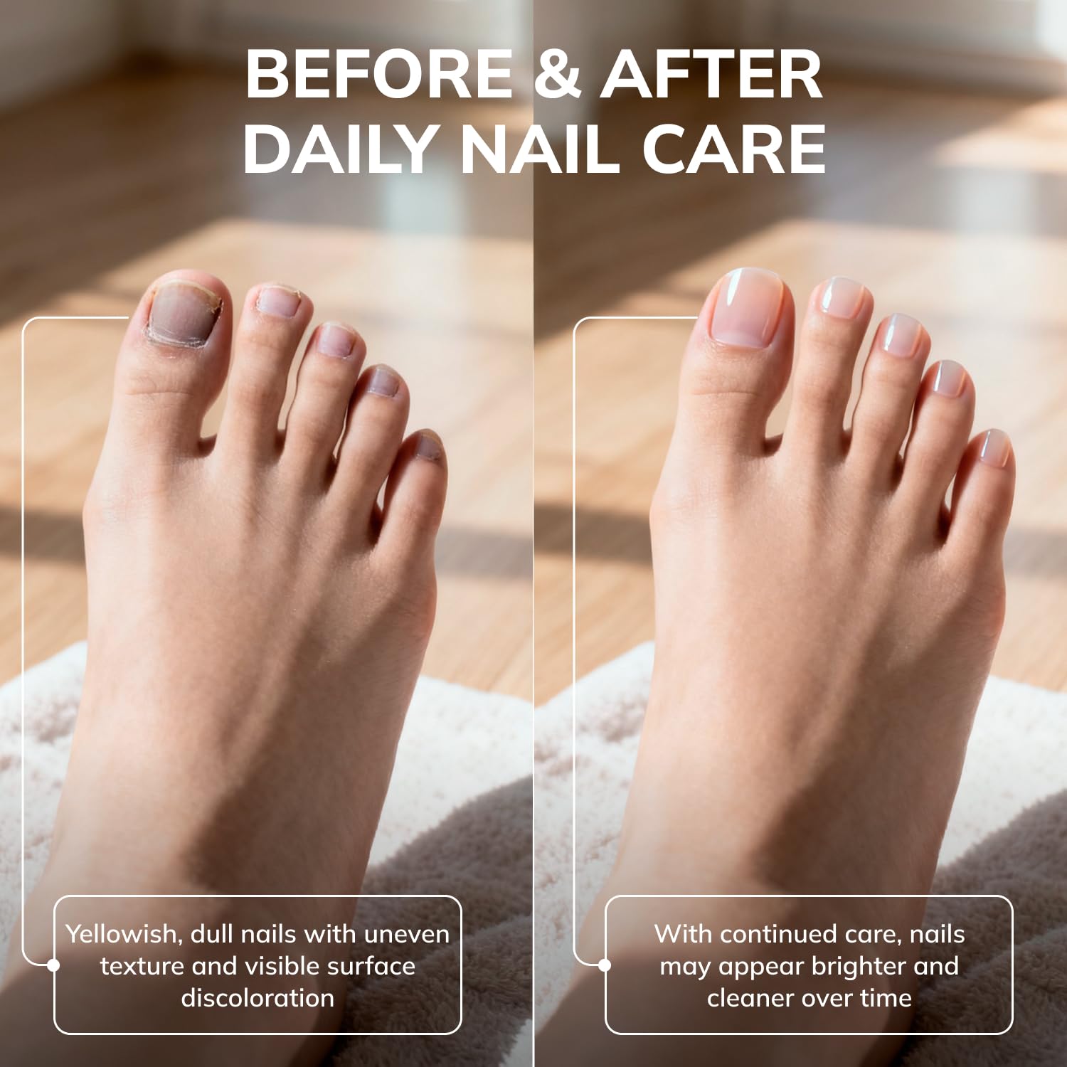 Close-up of nail-bed penetration concept with Swissklip KlearNail Stick