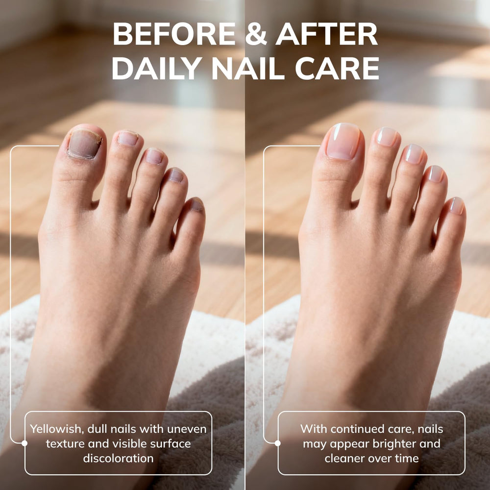 Close-up of nail-bed penetration concept with Swissklip KlearNail Stick