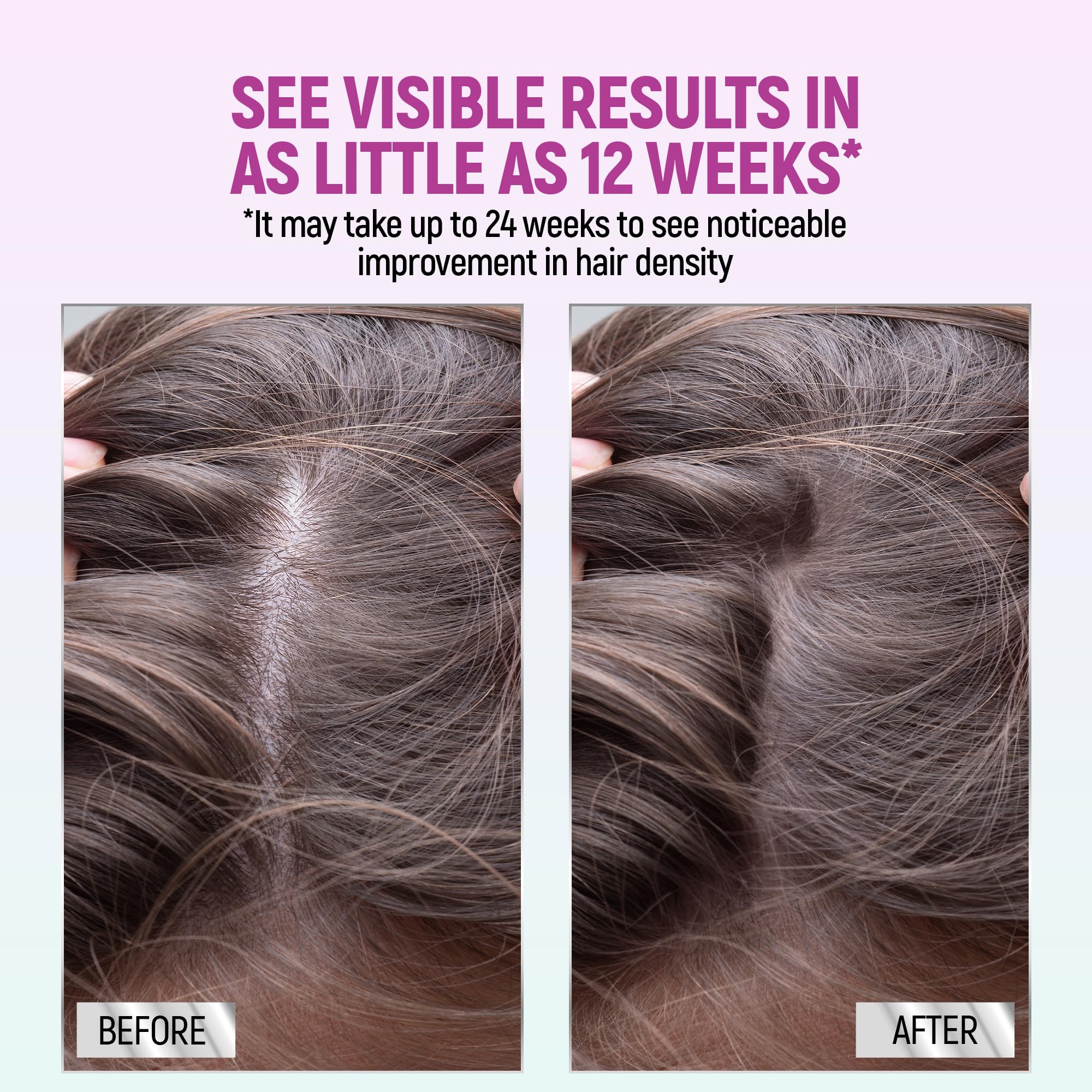 2-month TARO Minoxidil supply supports ongoing routine for thinning hair.