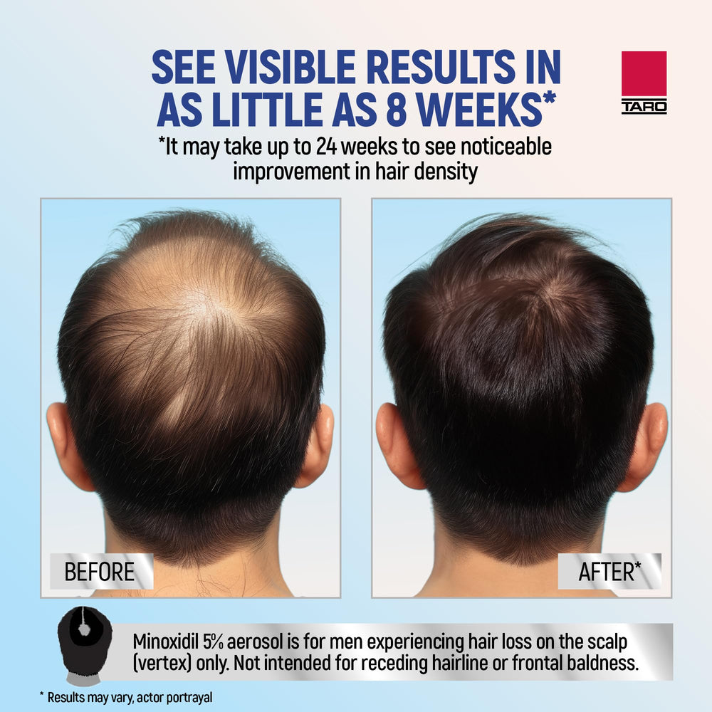 TARO Minoxidil foam applied to scalp in thinning area