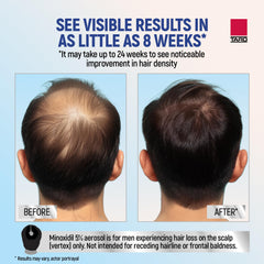 TARO Minoxidil foam applied to scalp in thinning area