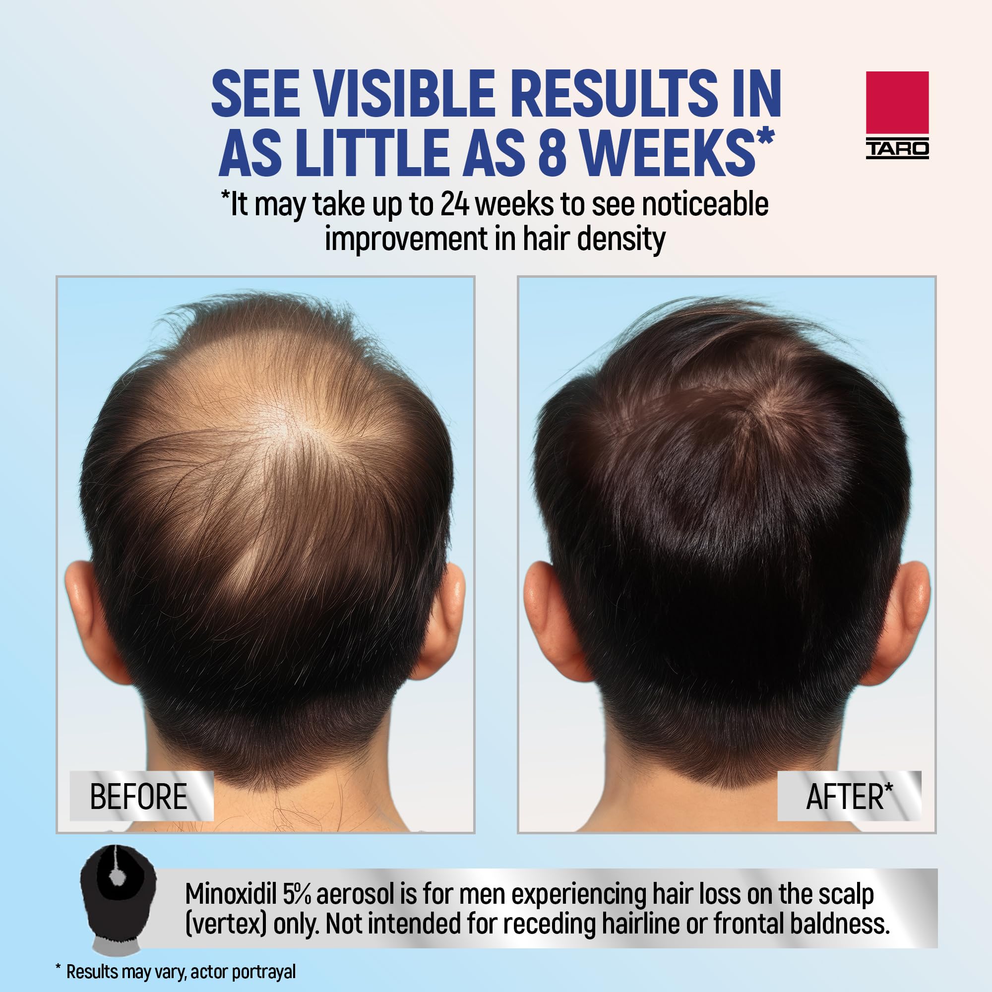 TARO Minoxidil in-use on scalp during routine