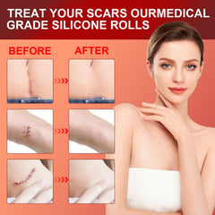 Tearich scar sheets on skin illustrate breathable, non-irritating scar treatment.