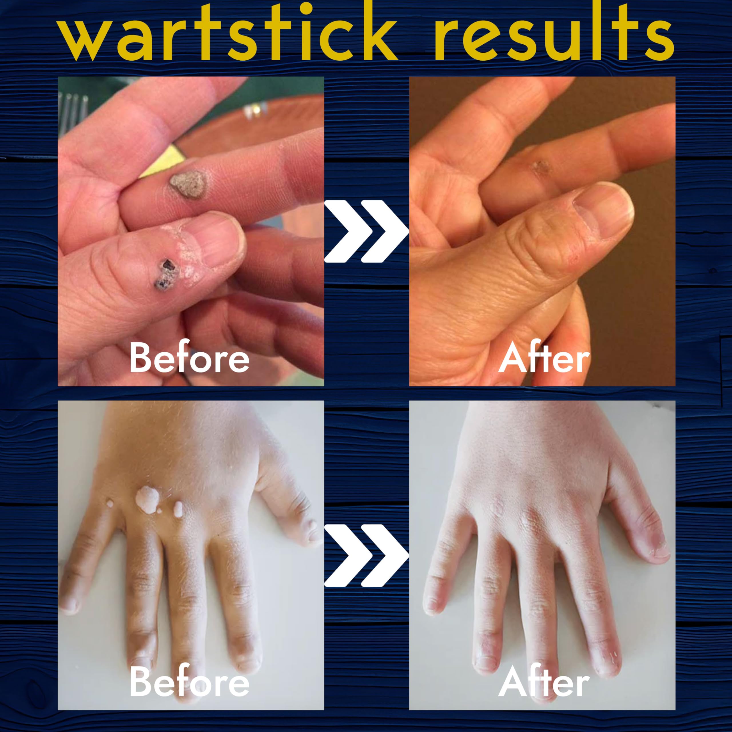 Terramed Just Think Comfort portable design enables easy at-home or on-the-go wart treatment.