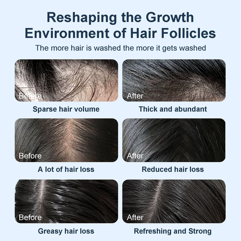 Tgideas dandruff-control shampoo bottle for balanced scalp care
