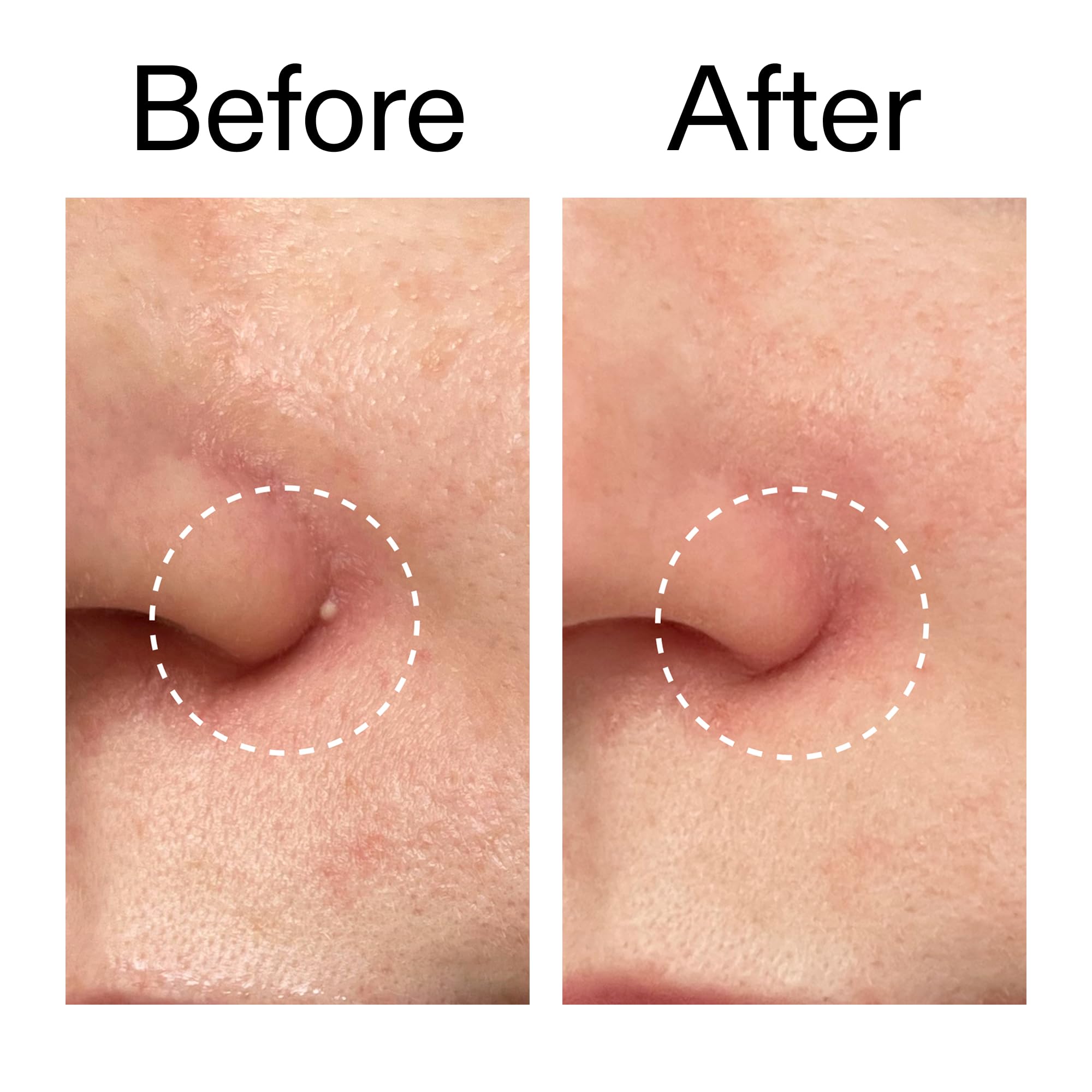 Patch reduces redness and protects breakout from irritation.