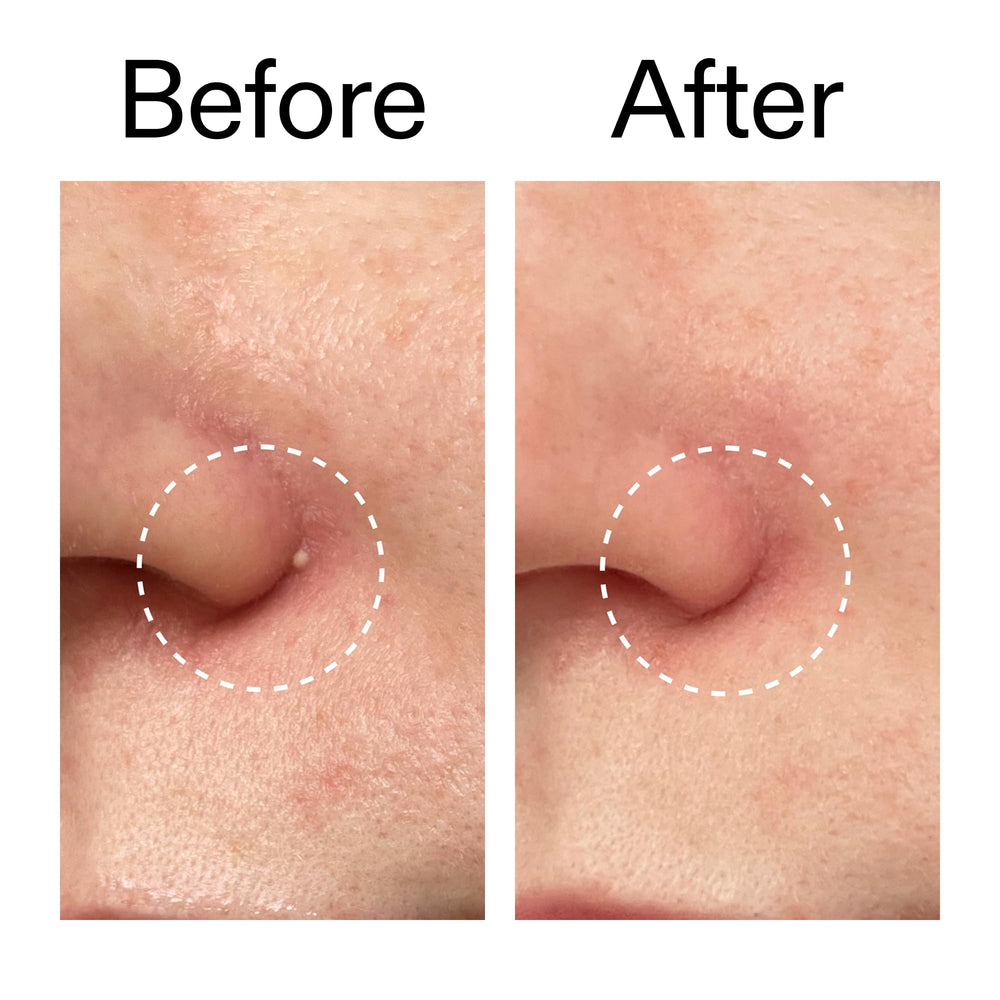 Patch reduces redness and protects breakout from irritation.