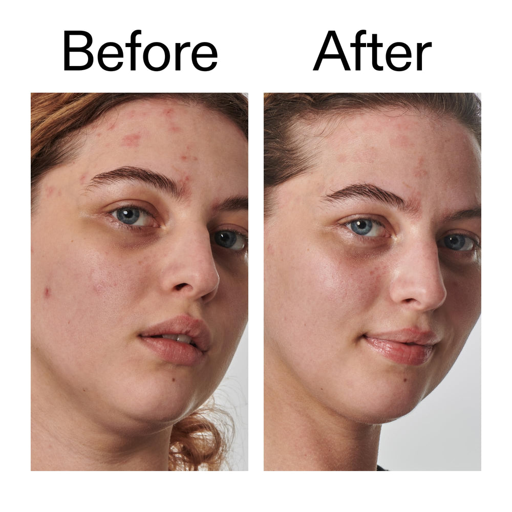Soothed dry skin area with The INKEY List moisturizer after application