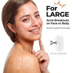 TKTK 8mm acne dot patch applied to a small spot