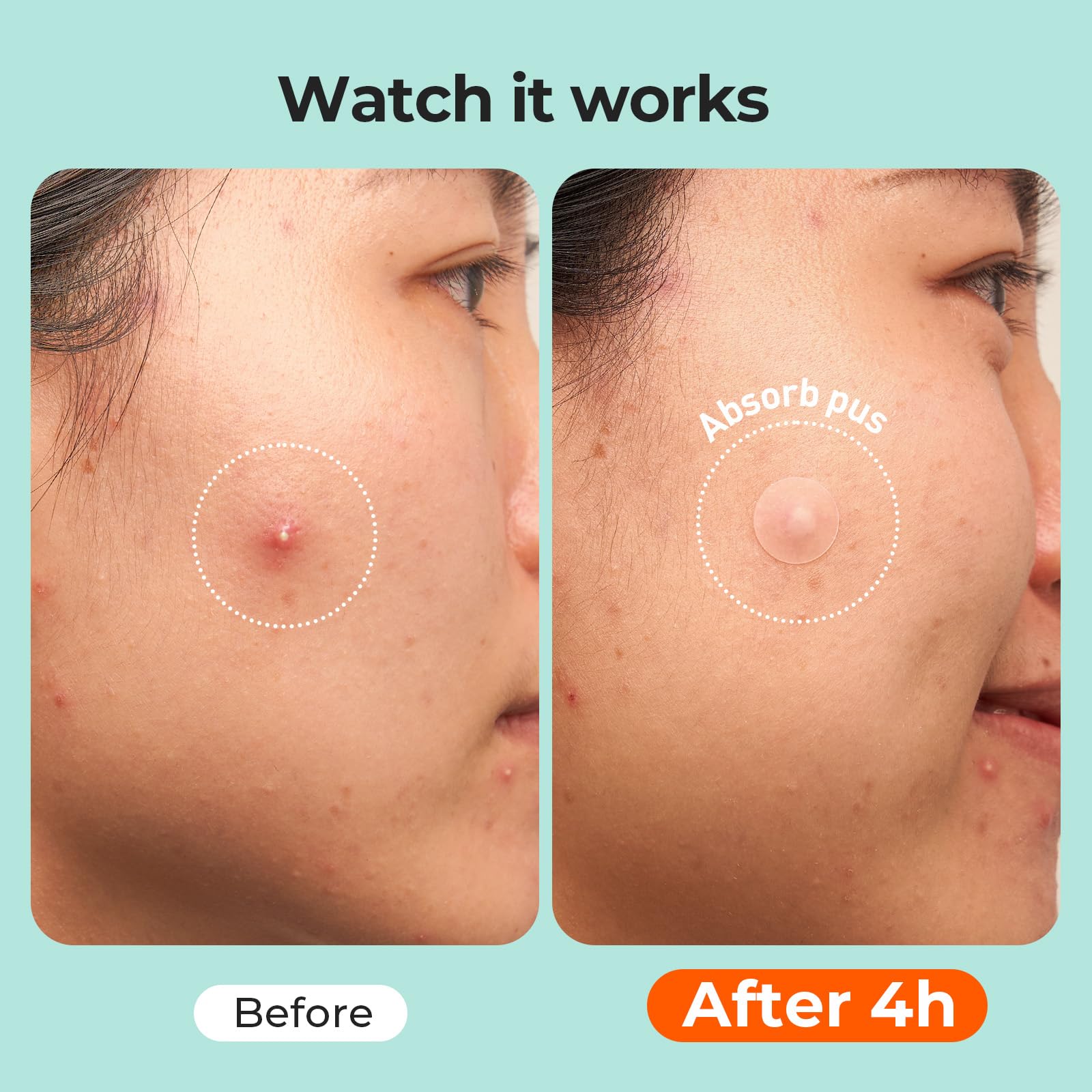 TKTK hydrocolloid core is odorless and skin-friendly for sensitive users.