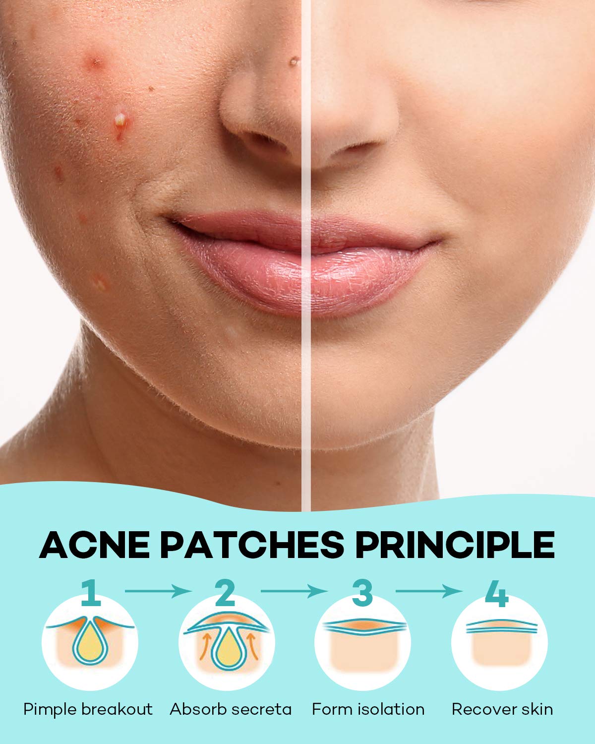 TKTK Pimple Patch invisible patch blends with skin tone for discreet wear.