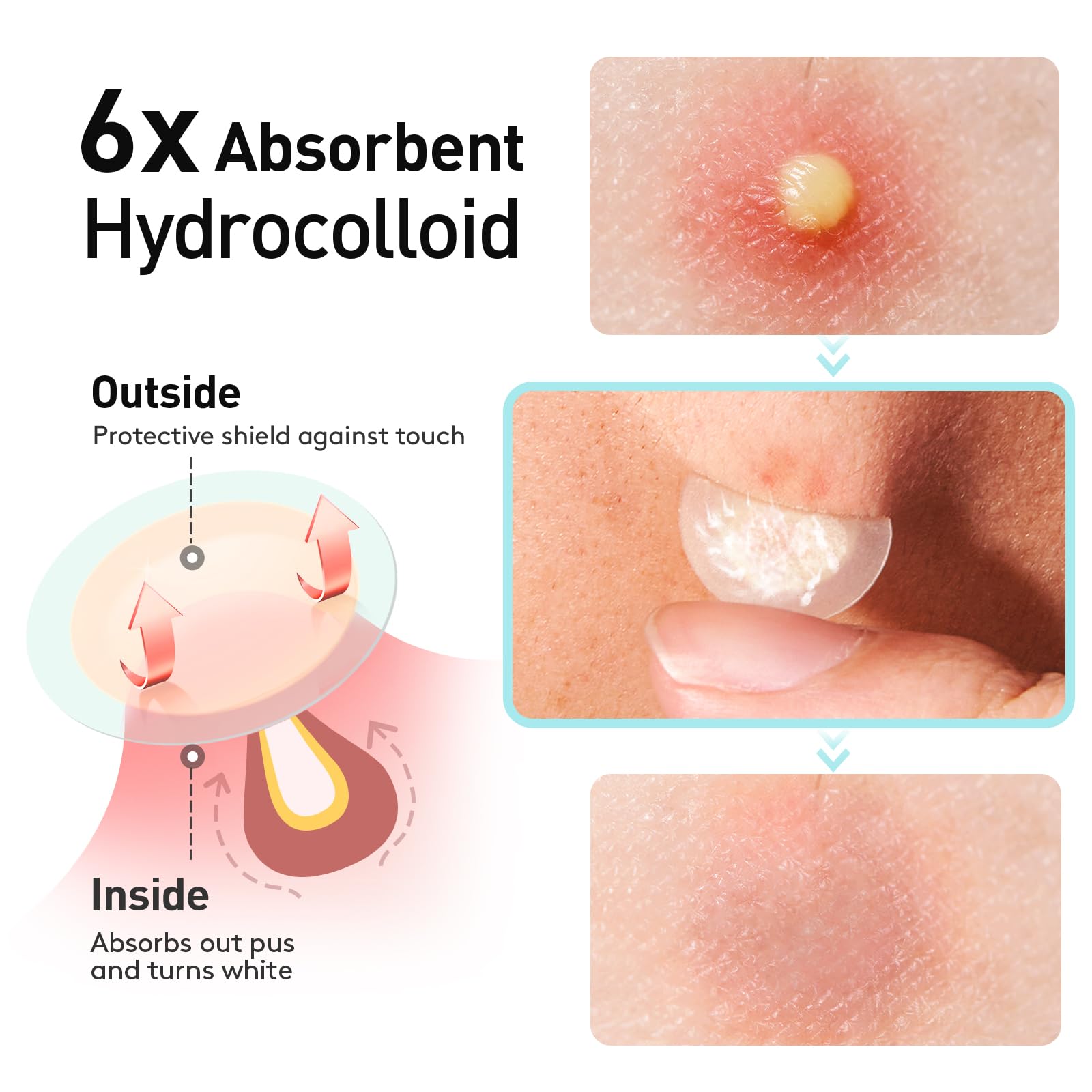 Hydrocolloid absorption layer capturing fluids from a blemish