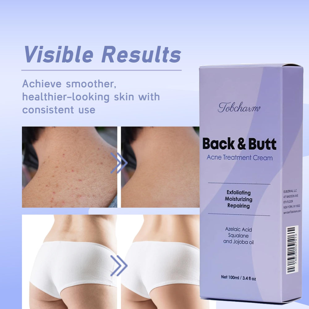 Tobcharm Body Care Cream pump offers versatile acne-prone skin care