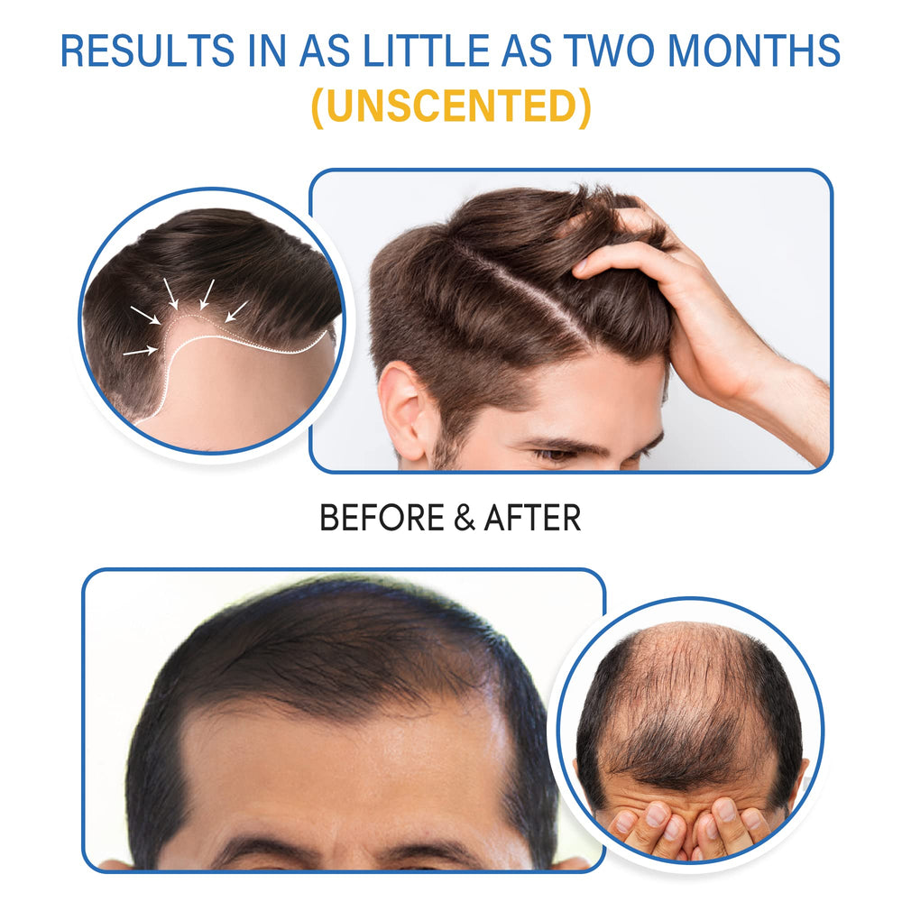 TOMUM 5% Minoxidil Foam focuses on part line thinning