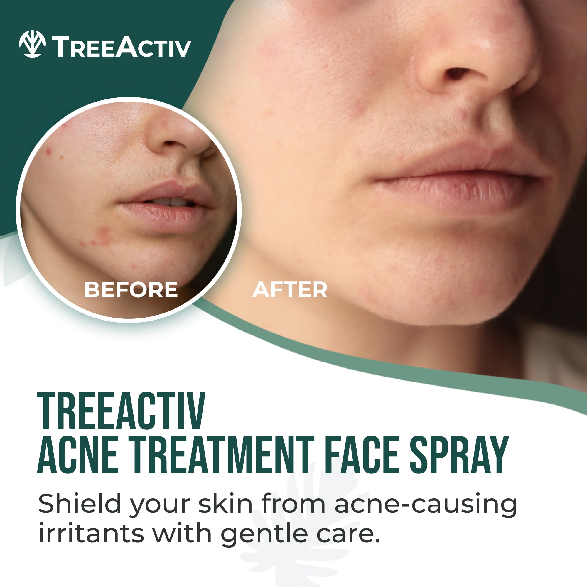 TreeActiv Acne Face Spray mist on face for quick hydration