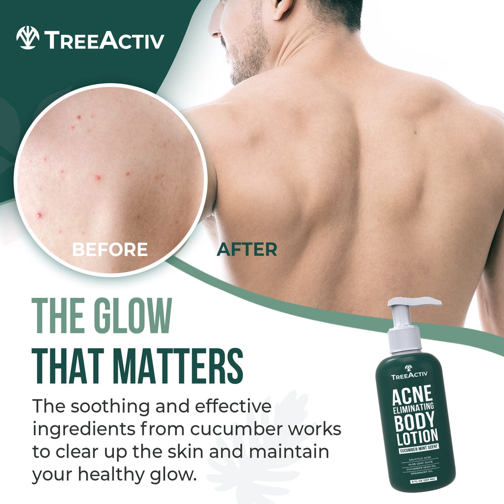 TreeActiv back acne solution bottle closeup showing fast-absorbing formula for acne-prone skin.