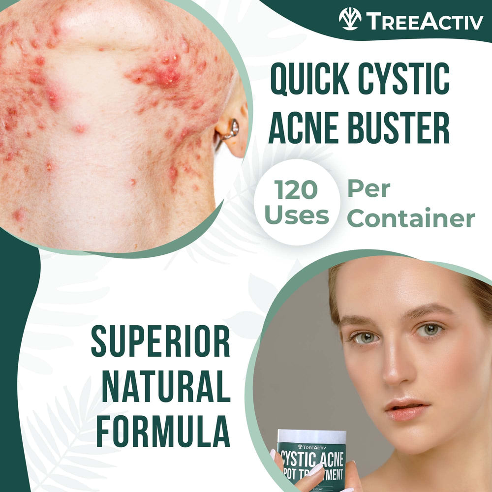 TreeActiv spot treatment applied on cheek demonstrates creamy texture