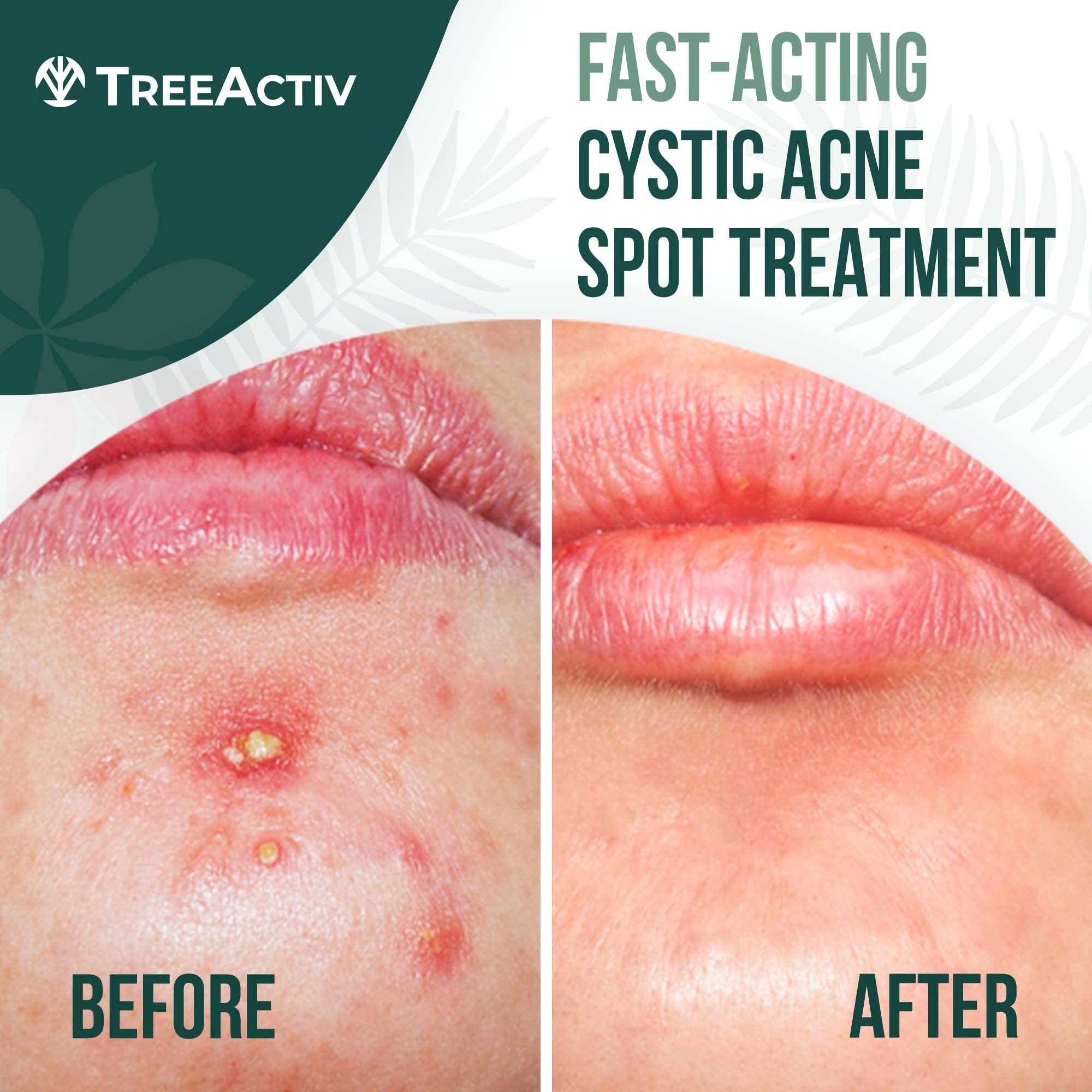 TreeActiv label close-up shows bentonite clay and sulfur ingredients