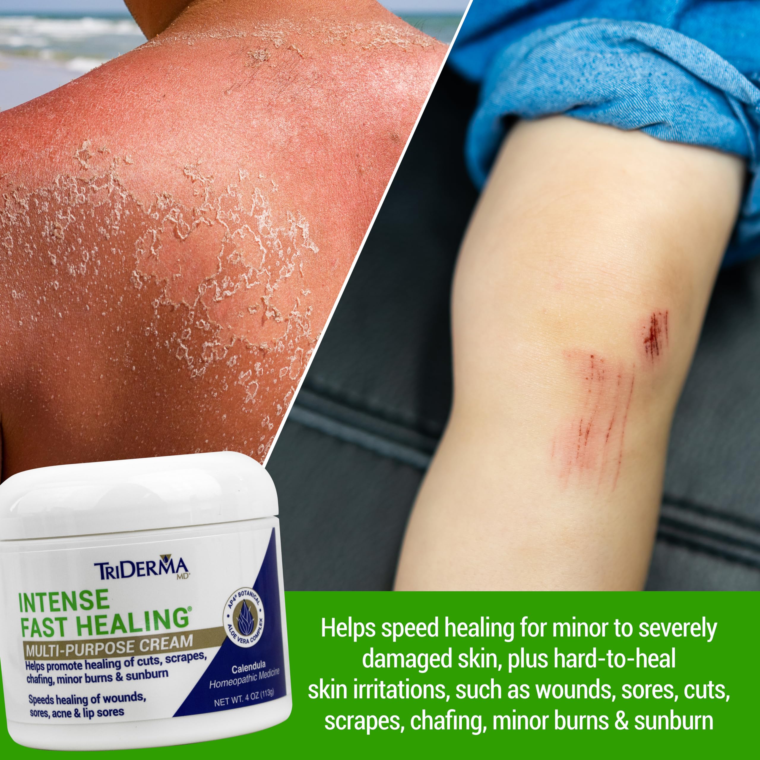 TriDerma Intense Fast Healing Cream on the face for gentle soothing use.