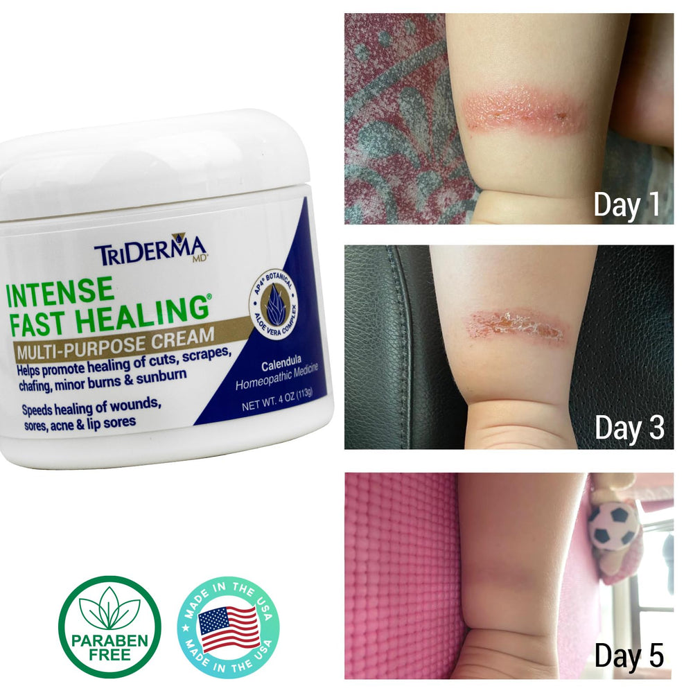 TriDerma Intense Fast Healing Cream hand application demonstrating quick absorption.