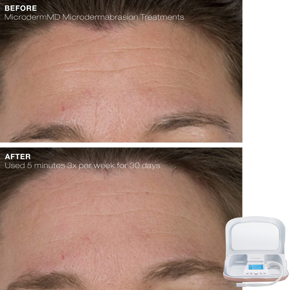 Trophy Skin MicrodermMD with infuser and accessories supporting at-home skincare routines