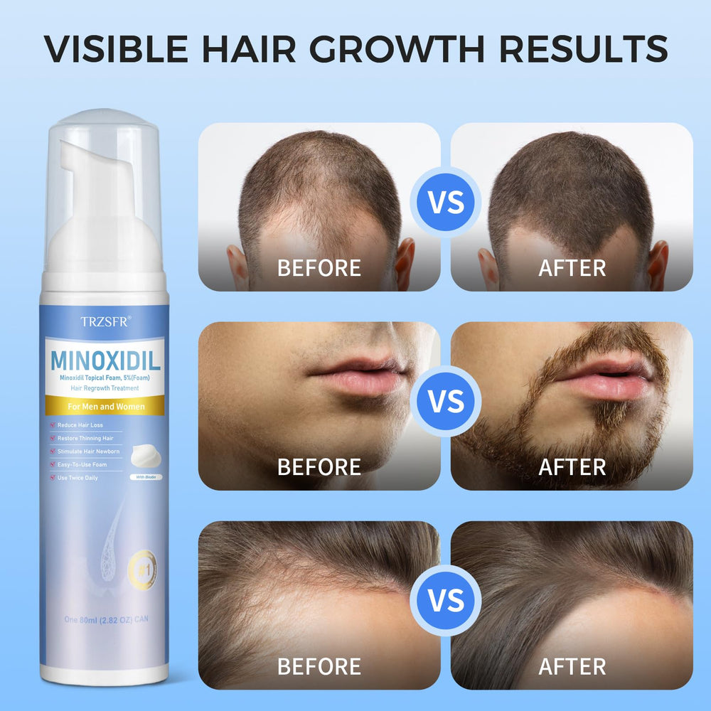 Trzsfr Minoxidil Foam on beard for potential facial hair growth.