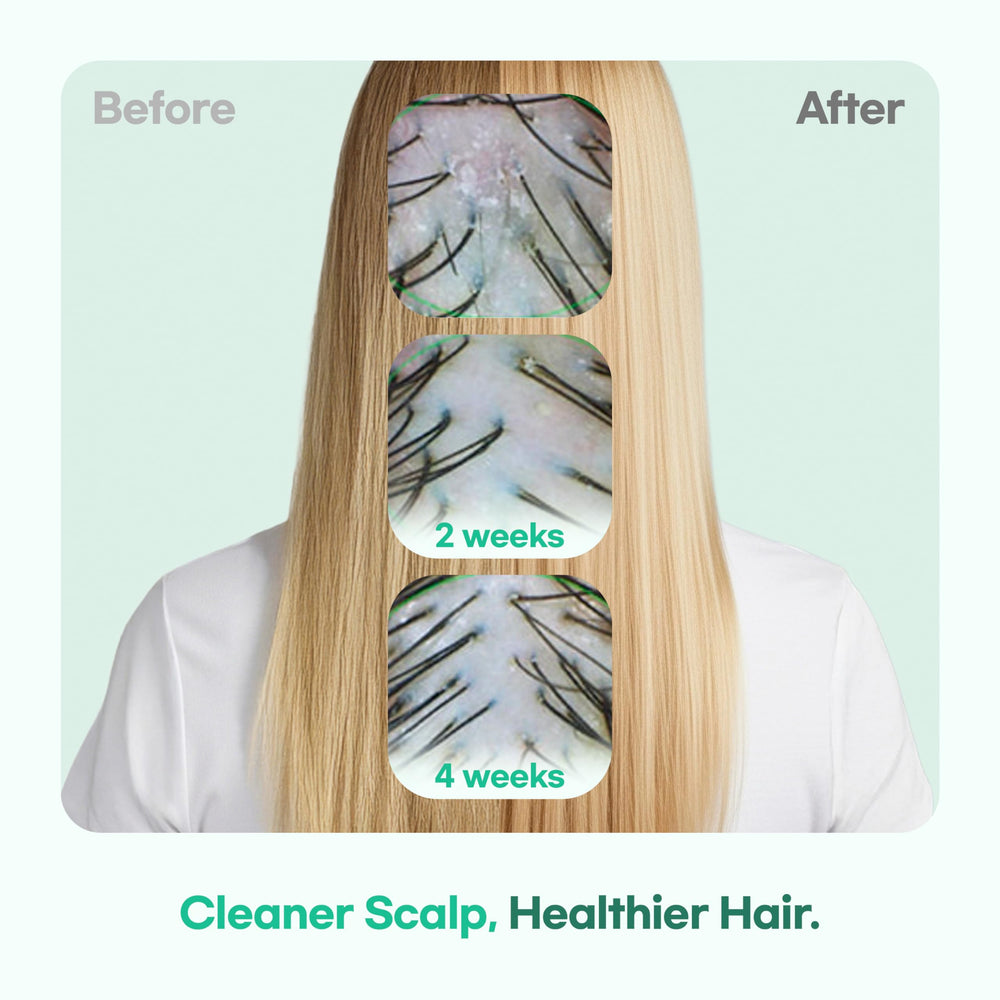 TS SHAMPOO teen scalp balance, calming itch and oil for daily use.