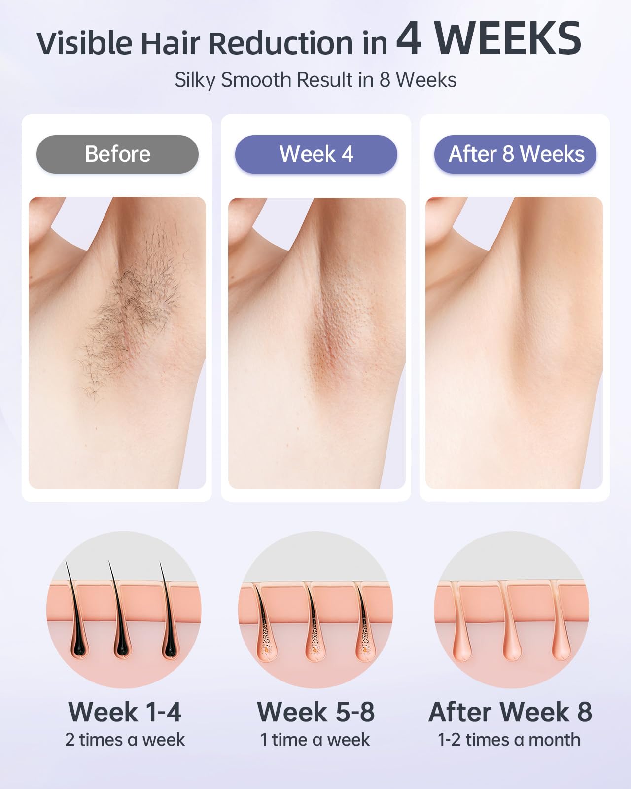 UENMOON IPL device bikini area view for precise targeting.
