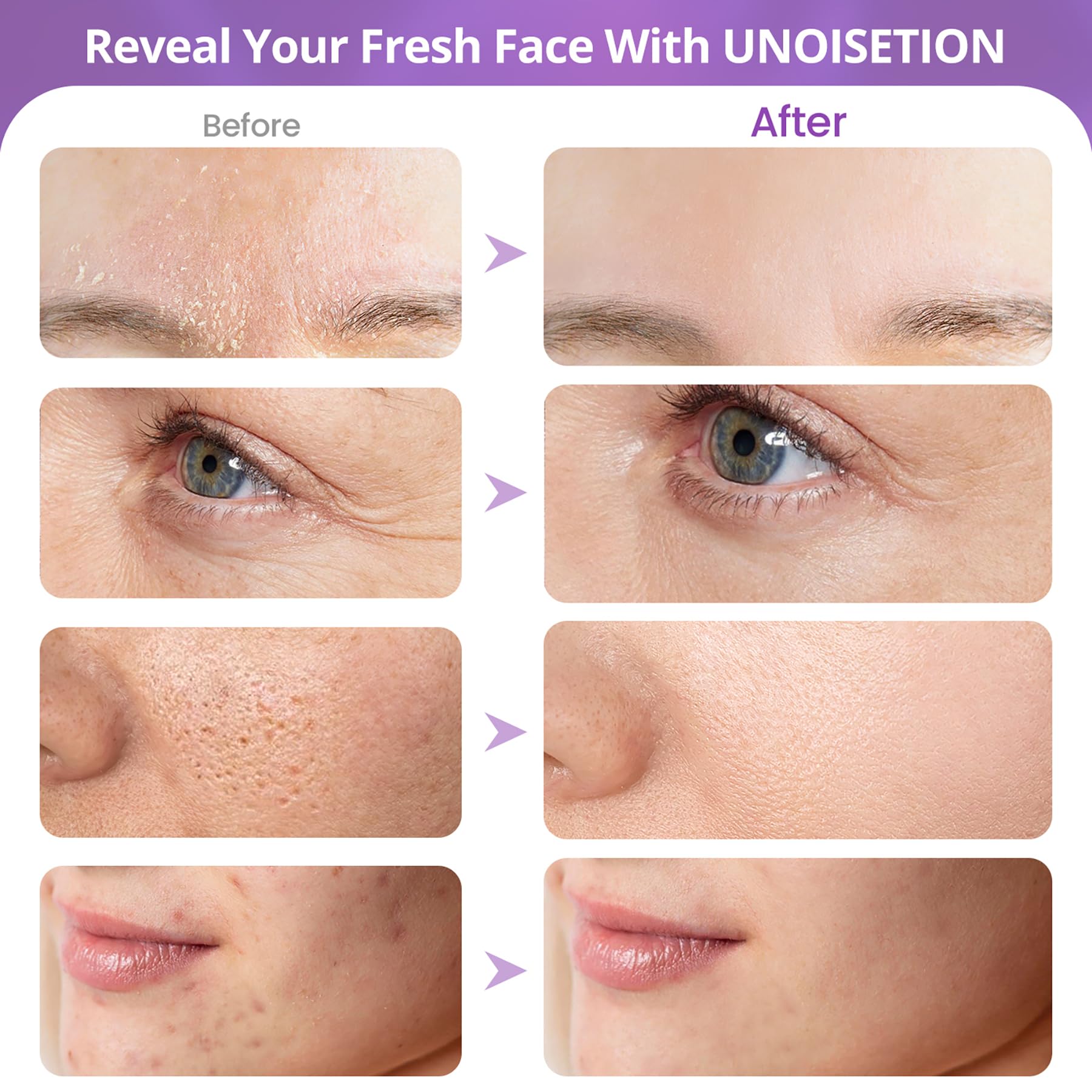 UNOISETION pores and fine lines improvement with regular sessions.