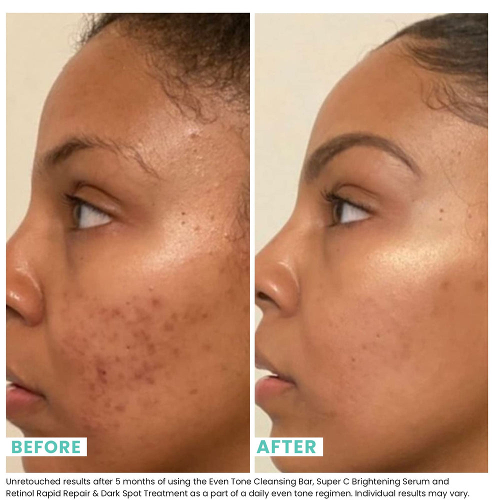 Urban Skin Rx Even Tone Cleansing Bar with exfoliating sponge promotes routine exfoliation