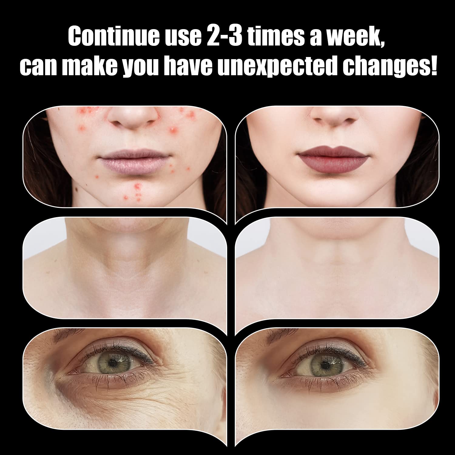 UUPAS bent tube attachment enables precise facial massage