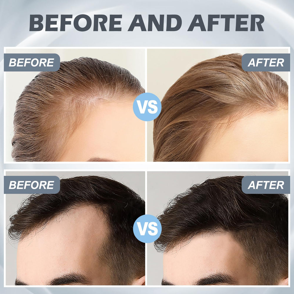 VANKEPYO derma roller for hair application to support scalp care.