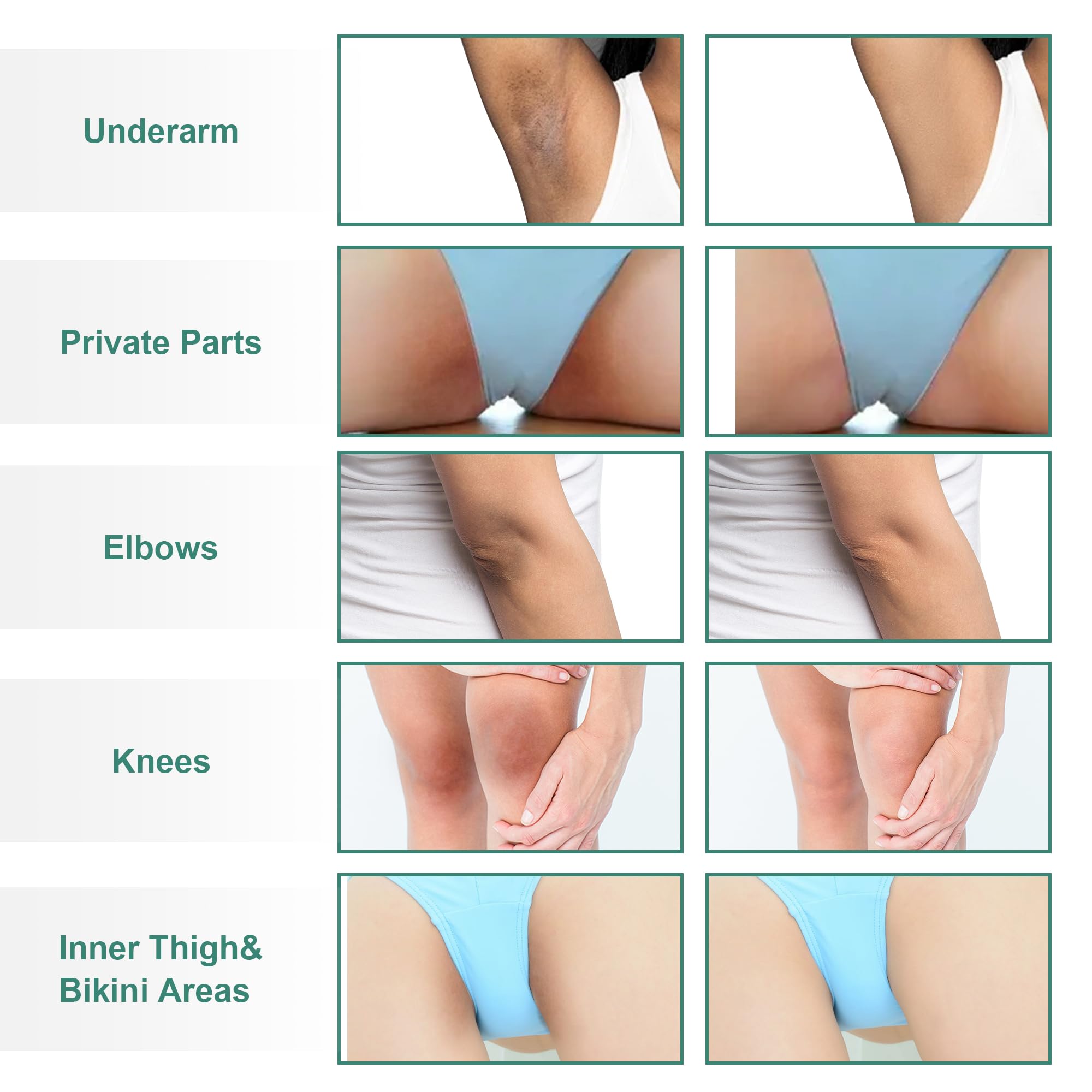 VCETREE knee and elbow brightening cream for even complexion