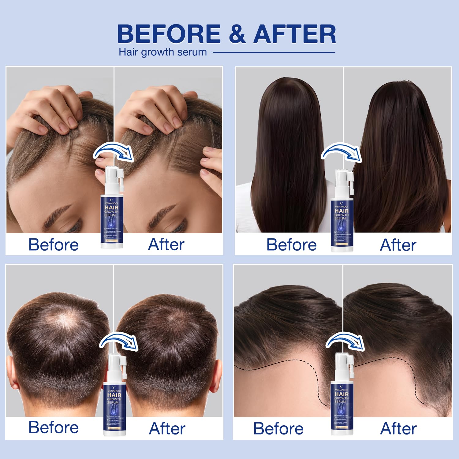 Venanoci rosemary infusion on the scalp suggests circulation support for healthier roots.