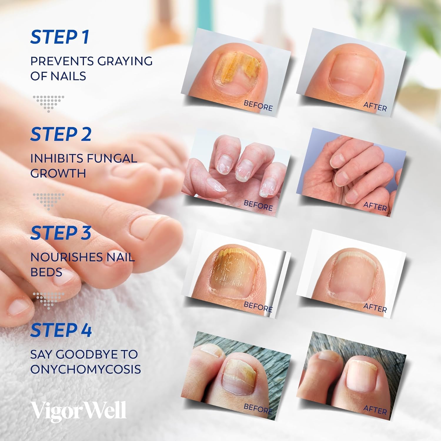 VigorWell complete nail repair solution for comprehensive toenail health improvement.