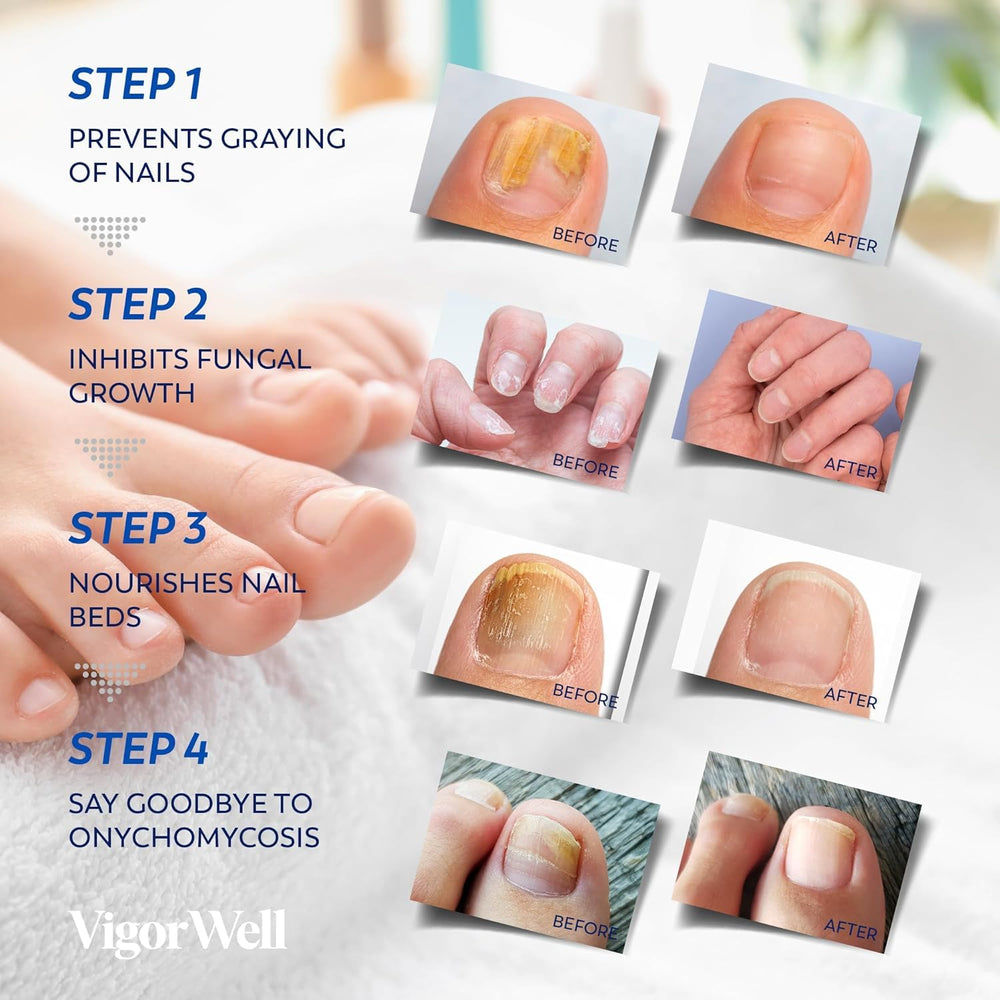 VigorWell complete nail repair solution for comprehensive toenail health improvement.