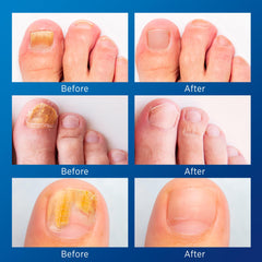 VigorWell nighttime patches used during sleep for eight-hour action on nails.