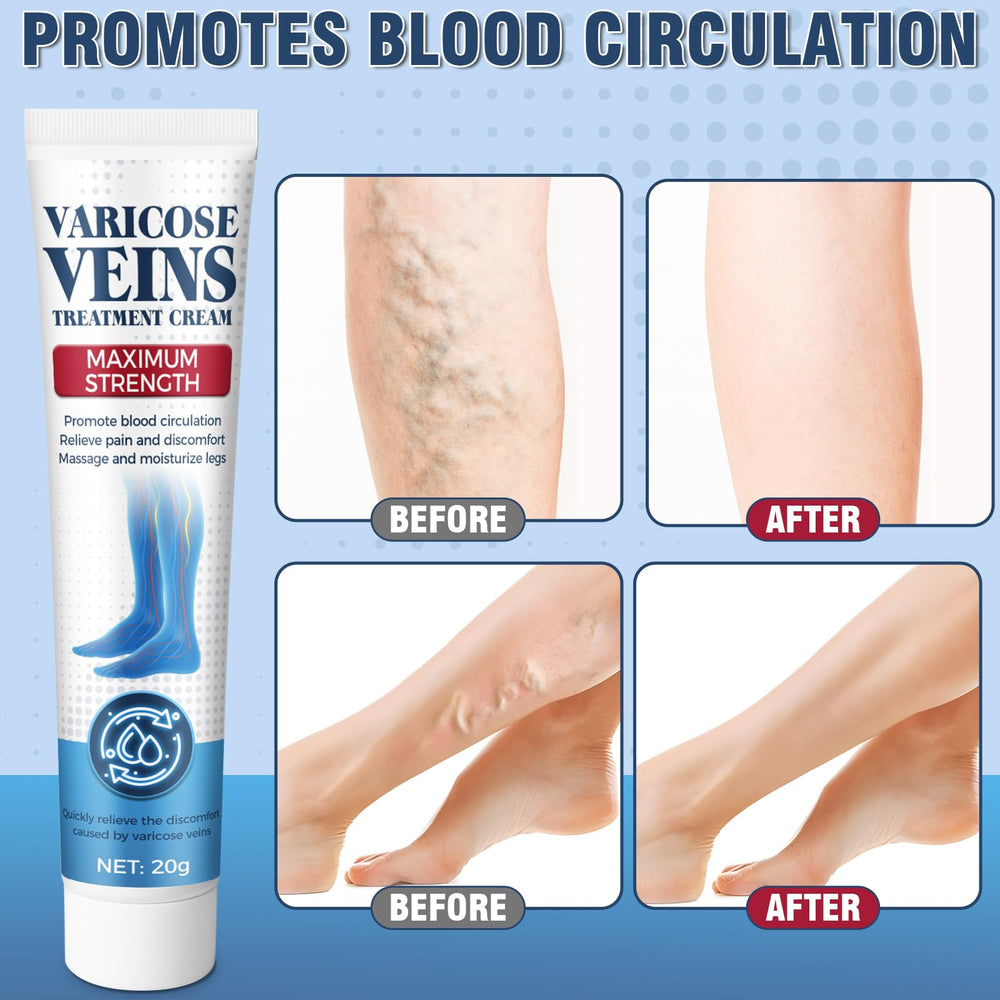 Wonshine varicose veins cream helps reduce swelling sensation with daily use.