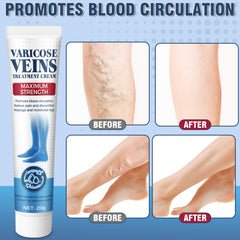 Wonshine varicose veins cream helps reduce swelling sensation with daily use.