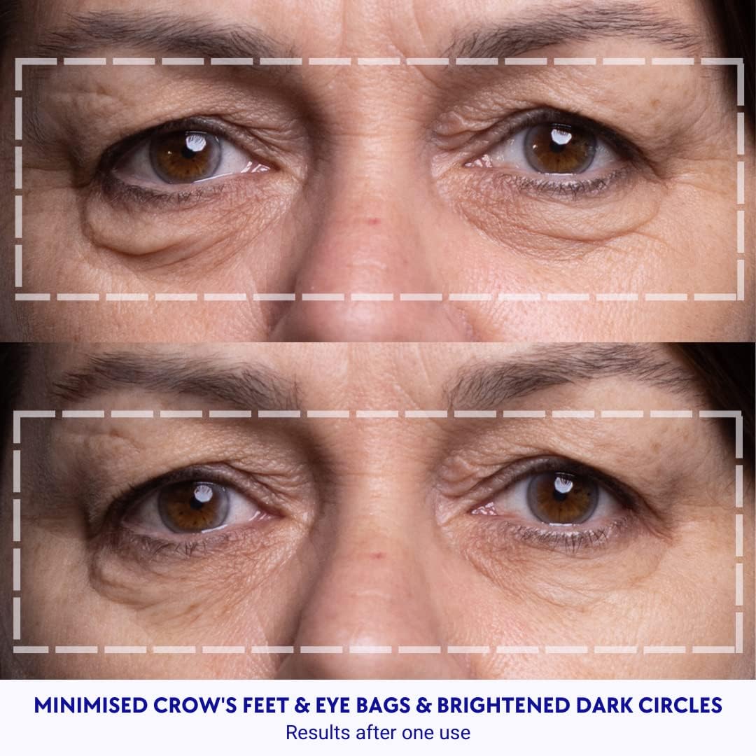 Wrinkles Schminkles under-eye patches on eye area for nightly routine